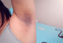 ¿Axilas oscuras y manchadas? Con esta pomada puedes aclararlas