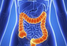 Cáncer colorrectal aumenta significativamente en los jóvenes en EEUU
