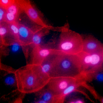 Errores en ADN contribuyen al cáncer, dicen científicos