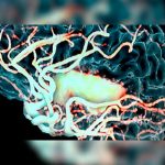 Desarrollan un aparato robótico para pacientes con secuelas por ictus