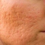 ¿Cómo pueden tratarse las cicatrices del acné?