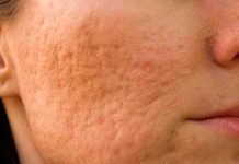 ¿Cómo pueden tratarse las cicatrices del acné?