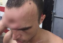 Un codazo deja desfigurado a un boxeador, mira el escalofriante video