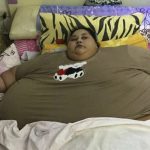 Egipcia operada en India pierde 240 kilos después de intervención