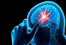 Aneurisma cerebral: enfermedad causada por el cigarrillo
