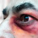 Chile anuncia su primer caso de ‘hongo negro’ vinculado a la COVID-19 chile, hongo negro, enfermedades infecciosas, covid-19,