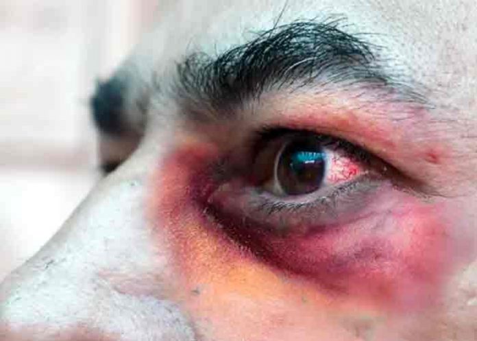 chile, hongo negro, enfermedades infecciosas, covid-19,