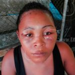 Mujer es agredida con arma blanca en Laguna de Perlas