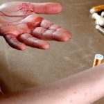 Nuevo desafío viral aterrador: Coserse la piel