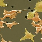 Cómo adelantarse a la metástasis