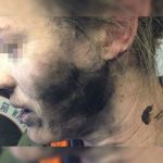 Una mujer sufrió quemaduras por explosión de sus auriculares en un vuelo hacia Australia