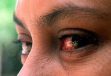 Uso de computadora genera síndrome de ojo seco