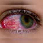 Inventan un pegamento que permite curar temporalmente heridas en los ojos