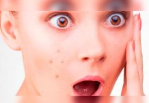 6 tipos de granos y cómo tratarlos según dermatólogos