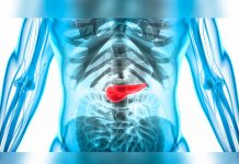 ¿Porqué el cáncer de páncreas es más mortal que los demás?