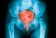 6 síntomas mortales de enfermedad pélvica que confundes con dolores menstruales