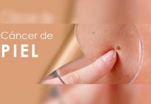 ¿Qué causa el cáncer de piel?