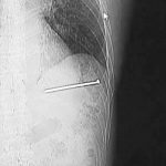 Se dispara una pistola de clavos en el corazón, se limpia y maneja hasta el hospital (FOTOS)