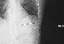 Se dispara una pistola de clavos en el corazón, se limpia y maneja hasta el hospital (FOTOS)
