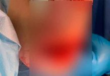 ¡Dantesco! Joven termina mordida por un pez en playa de Puerto Rico (Fotos) fotos, puerto rico, pez, mordida, playa, insolito,