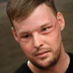 Hombre recibe trasplante de rostro tras 56 horas de cirugía