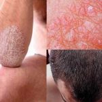 ¿Qué es y cómo se trata la psoriasis?