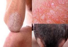 ¿Qué es y cómo se trata la psoriasis?