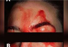 Joven italiana suda sangre por sus manos y rostro