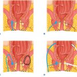 Conozca el síndrome de la úlcera rectal solitaria y sus consecuencias