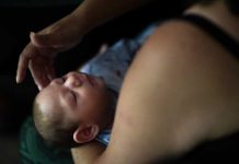 Cifra de defectos por zika en EEUU es similar a otros sitios