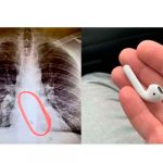 Hombre sobrevive tras tragarse uno de sus AirPods mientras dormía estados unidos, sobreviviente, hombre, tragar, airpods, dormido,