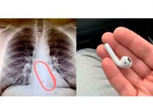 Hombre sobrevive tras tragarse uno de sus AirPods mientras dormía estados unidos, sobreviviente, hombre, tragar, airpods, dormido,