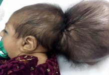 Operan con éxito a bebé con dos cráneos