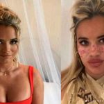 Siguió tutorial para ponerse pecas, se quemó la piel y terminó con ceguera australia, influencer, tutorial, video, tik tok, afectaciones, piel,