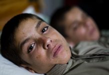 La curiosa enfermedad de los «niños solares» de Pakistán