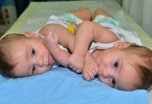Mueren siamesas paraguayas que compartían órganos vitales