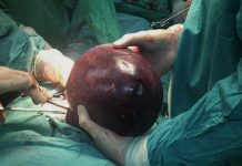 Extraen con éxito un tumor de 13 libras a hondureña
