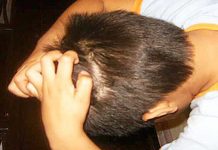 Polémica por menores con piojos en Costa Rica