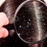 tips, remedios caseros, caspa, efectividad,