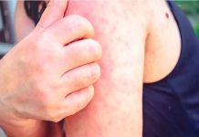 enfermedad, estafilocócico, piel escaldada, salud,