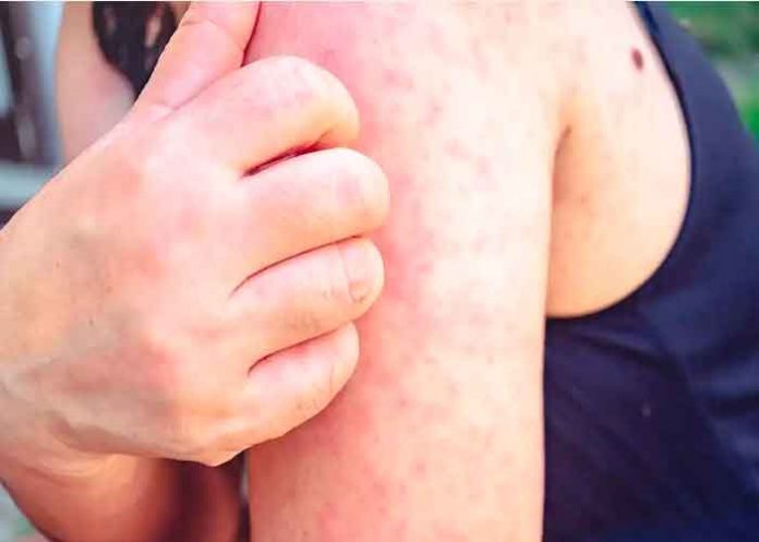 enfermedad, estafilocócico, piel escaldada, salud,