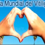 Vitiligo, diagnóstico, tratamiento, enfermedad,