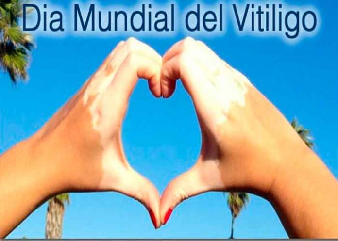 Vitiligo, diagnóstico, tratamiento, enfermedad,