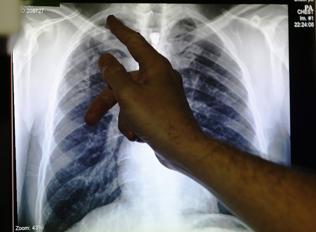 Clinical lead Doctor Al Story points to an x-ray showing a pair of lungs infected with TB (tuberculosis) during an interview with Reuters on board the mobile X-ray unit screening for TB in Ladbroke Grove in London