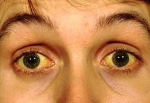 Remedios caseros para los ojos amarillos