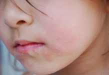 Investigadores logran combatir alergia a los cacahuetes entre niños