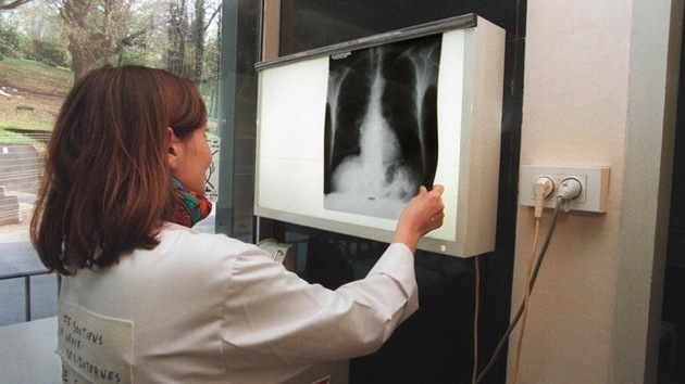 images_SECCIONES_PAGINA_WEB_ULTIMA_HORA_2014_FEBRERO_DEL_17_AL_23_pulmones17022014