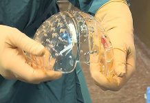 Operación única: sustituyen el cráneo de una mujer por uno de plástico impreso en 3D