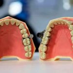 Crean dispositivo dental que te cierra la boca para bajar de peso (FOTO) insolito, viral, dieta, metodo, iman, dispositivo dental, dentalslim diet control, twitter,