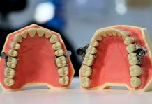 Crean dispositivo dental que te cierra la boca para bajar de peso (FOTO) insolito, viral, dieta, metodo, iman, dispositivo dental, dentalslim diet control, twitter,